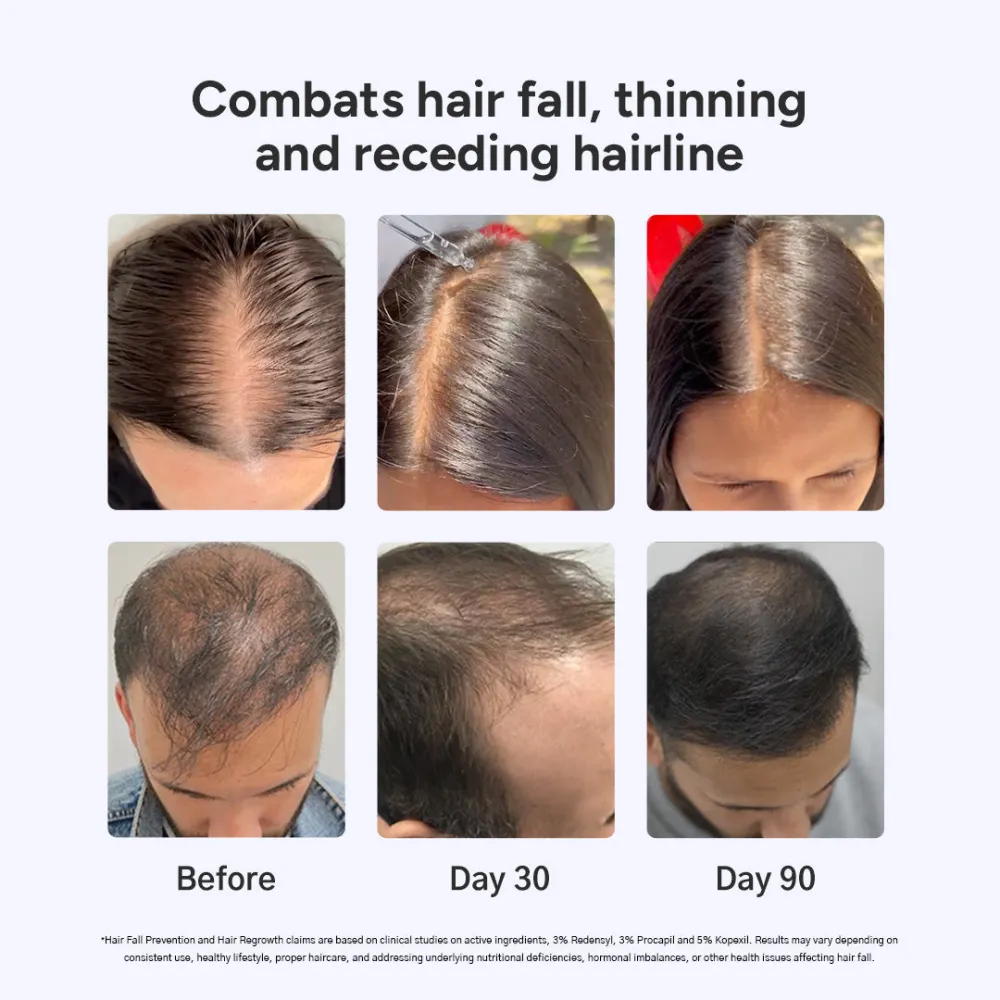Intensive Hair Growth Serum: Buy 2, Get 1 Free + Free Derma Roller - Image 4